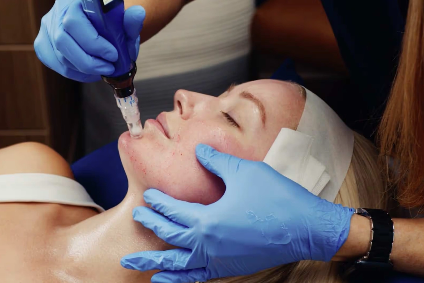 процедура Микронидлинг със SkinPen® в клиника